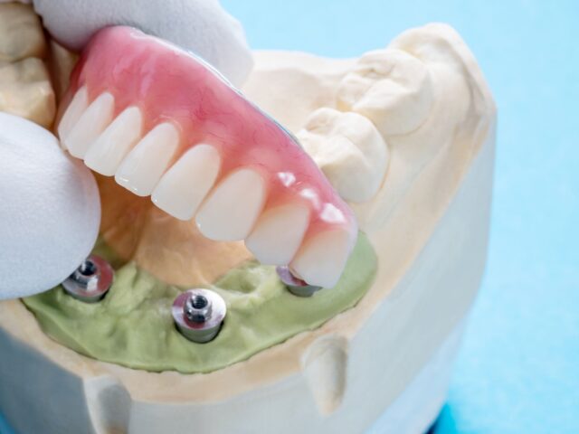 All-on-4 Dental Implants
