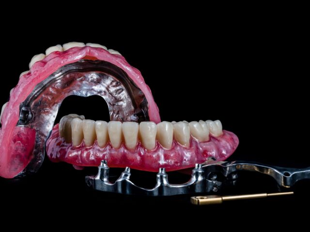 All-on-6 Dental Implants