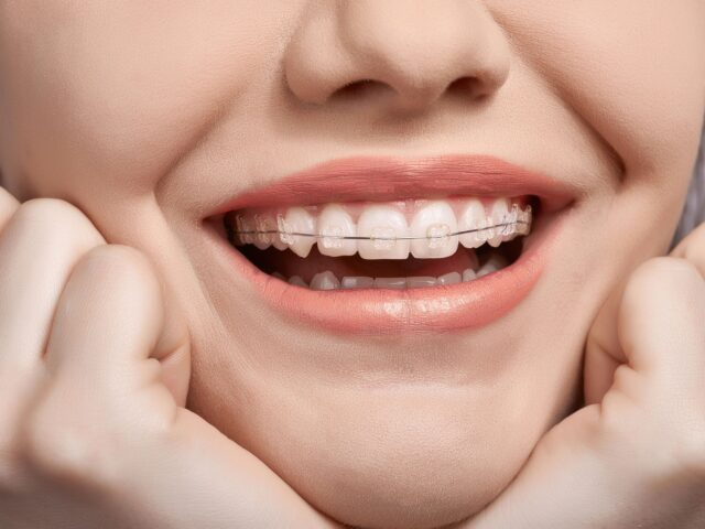 Ceramic braces - 2 Ceramic Braces