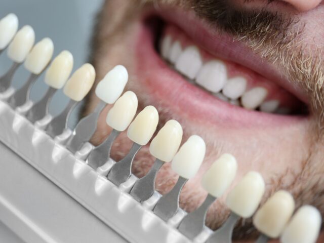 Composite Veneers
