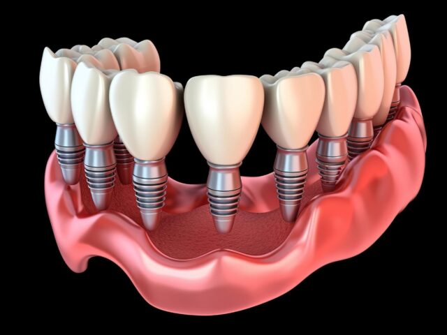 Full Mouth Dental Replacement