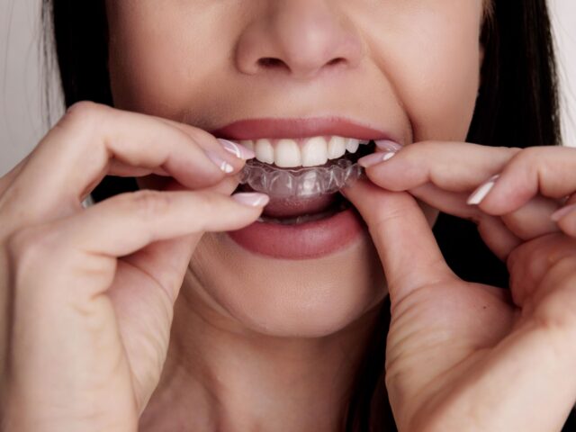 Indian Aligners