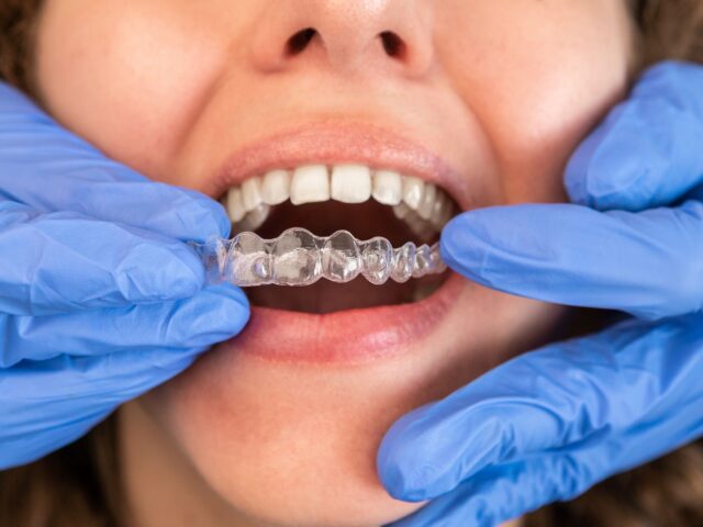 https://www.inwhitedental.in/wp-content/uploads/2024/07/Invisible-Aligners-2-640x480.jpg