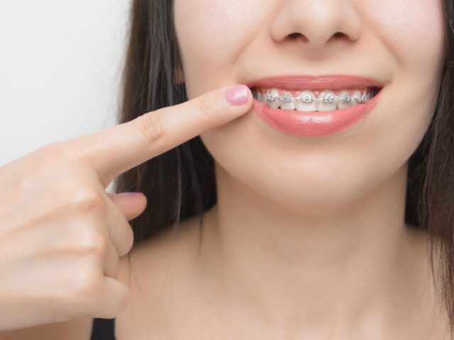 Self ligating braces - 2 Self Ligating Braces