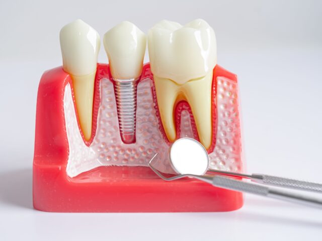 Single Tooth Replacement - 2 Single Tooth Replacement