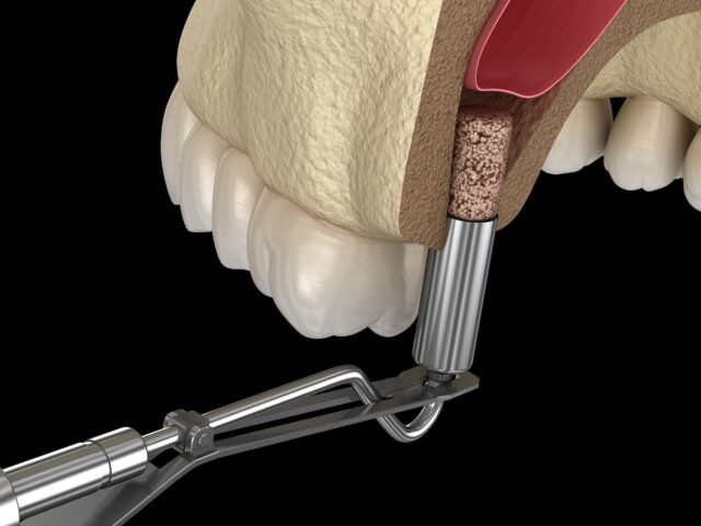 Sinus Lift