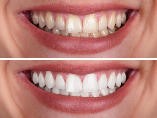 Teeth Whitening