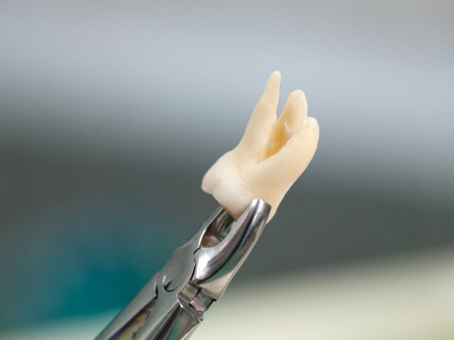 Wisdom Tooth Removal