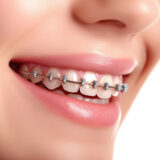 types of braces
