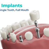 inwhite dental implant