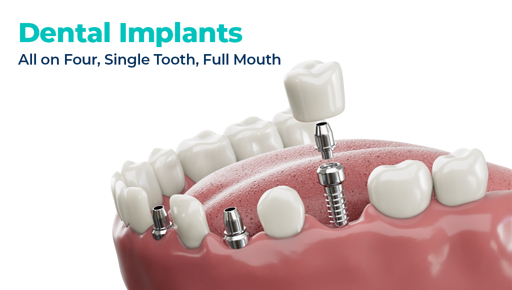 inwhite dental implant