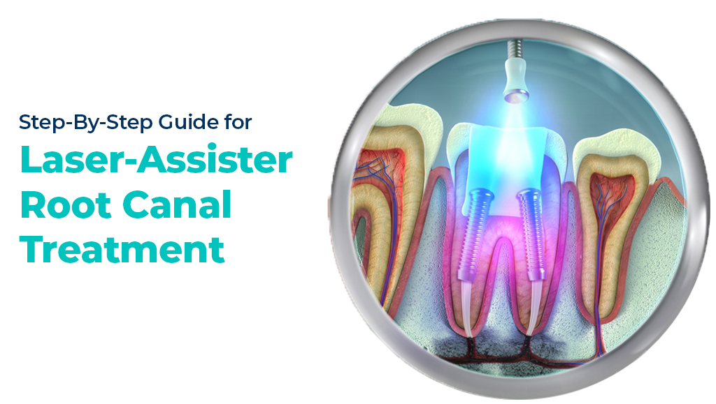 root canal is performed with laser dentistry