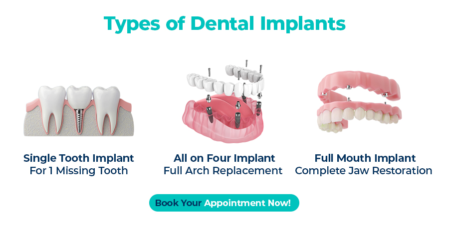 types of dental implant