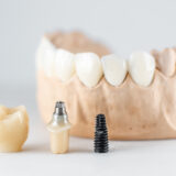 dental implants