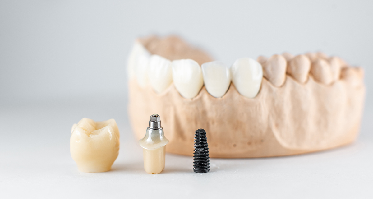 dental implants